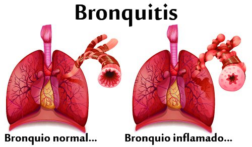 Lo que debe saber sobre la bronquitis o resfriado de pecho